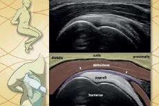 Ultrazvuk myoskeletální