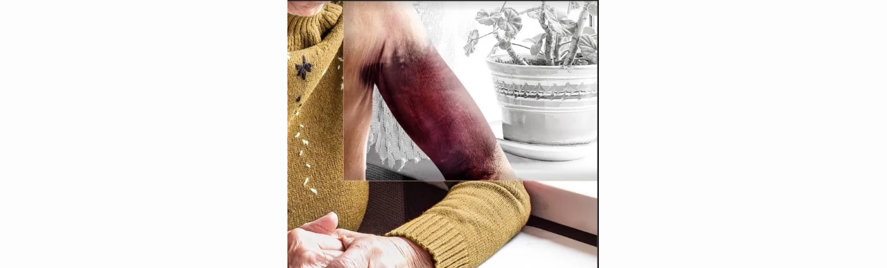 Cílená diagnostika a léčba získané hemofilie A